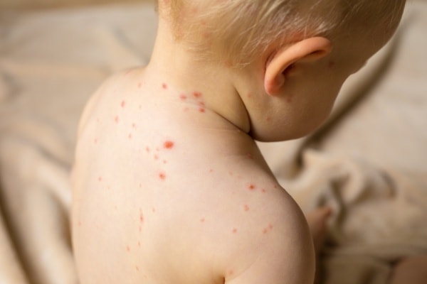 Как выглядит укус комара у ребенка фото